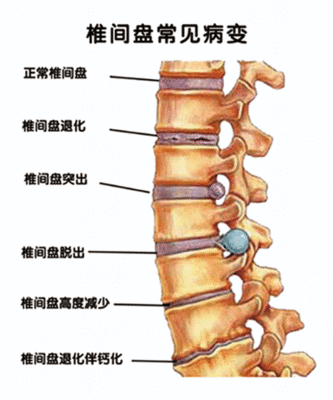 从腰疼的姿势看出病因
